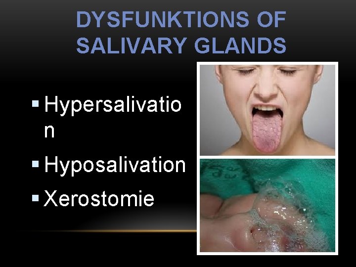DYSFUNKTIONS OF SALIVARY GLANDS § Hypersalivatio n § Hyposalivation § Xerostomie 