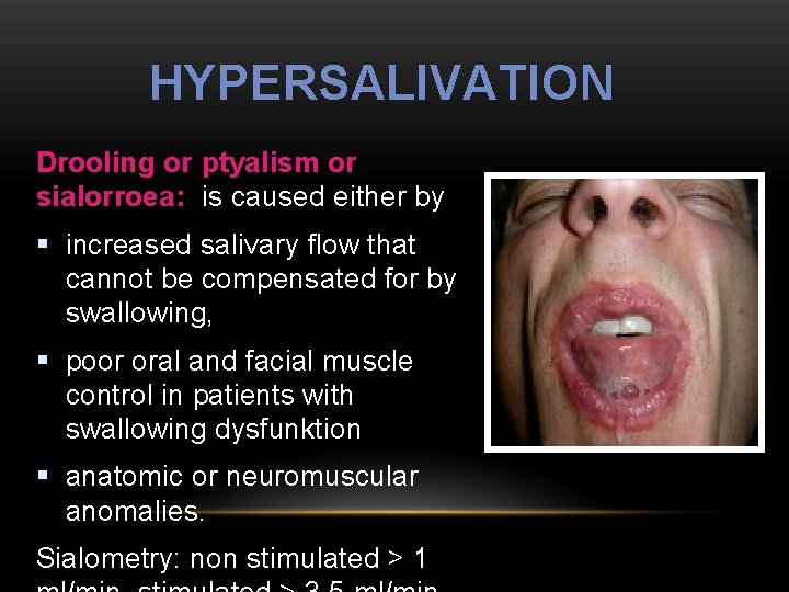 HYPERSALIVATION Drooling or ptyalism or sialorroea: is caused either by § increased salivary flow