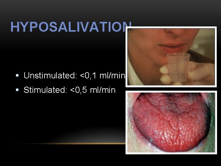 HYPOSALIVATION § Unstimulated: <0, 1 ml/min § Stimulated: <0, 5 ml/min 