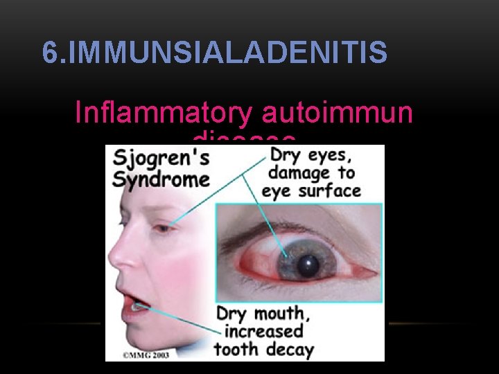 6. IMMUNSIALADENITIS Inflammatory autoimmun disease Zielpopulation: Frauen in der Menopause 