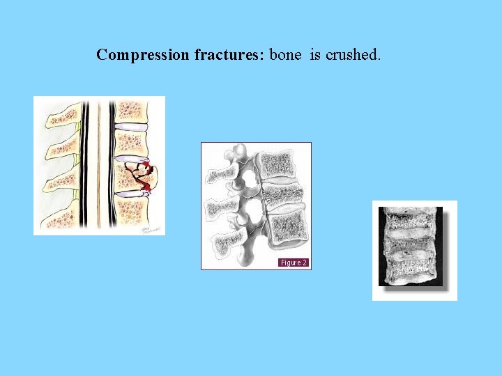 Compression fractures: bone is crushed. 