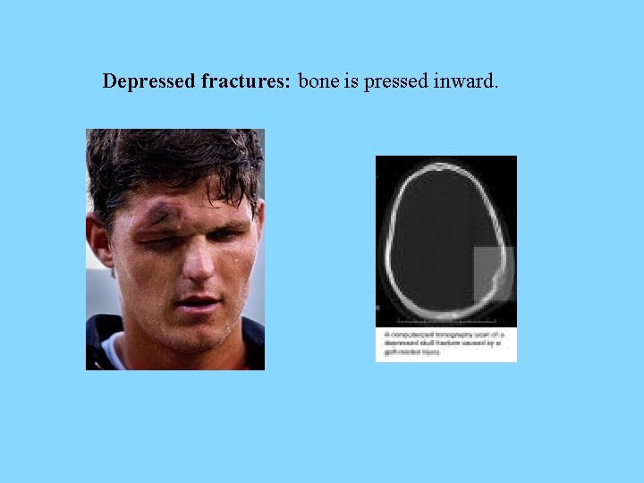 Depressed fractures: bone is pressed inward. 