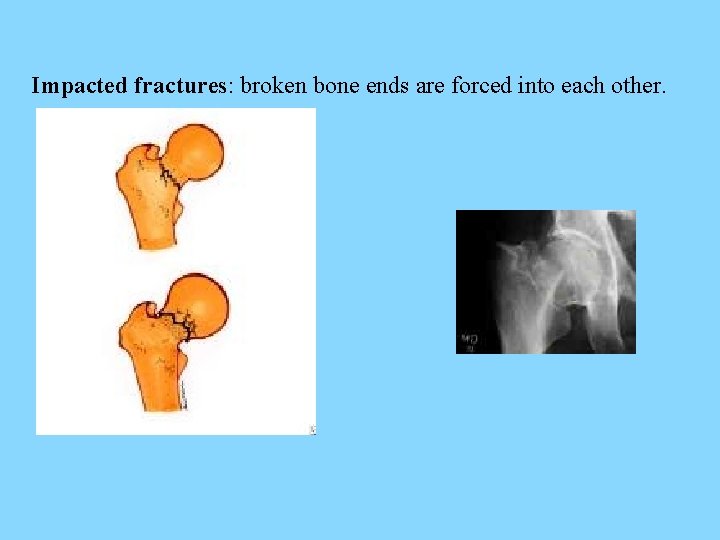 Impacted fractures: broken bone ends are forced into each other. 