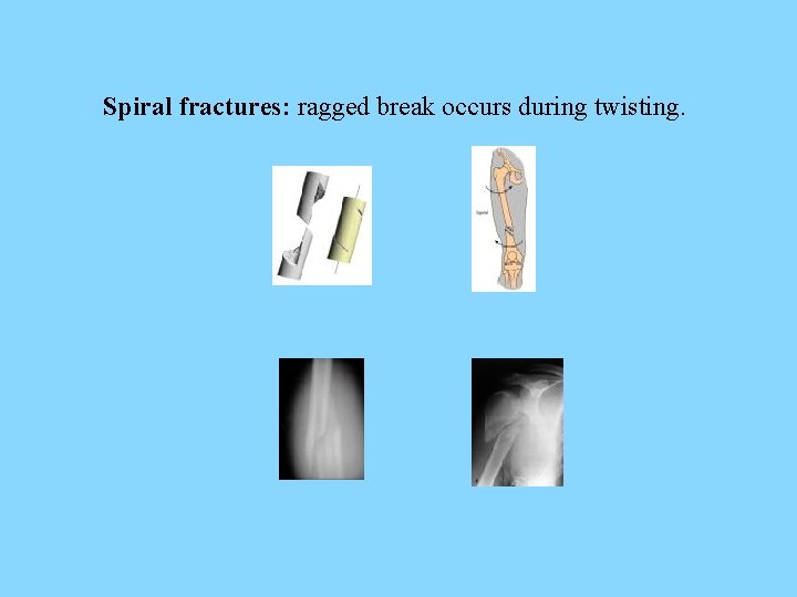 Spiral fractures: ragged break occurs during twisting. 