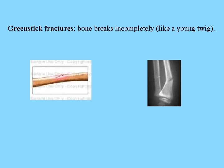 Greenstick fractures: bone breaks incompletely (like a young twig). 