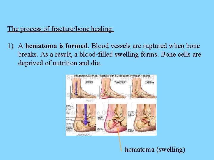 The process of fracture/bone healing: 1) A hematoma is formed. Blood vessels are ruptured