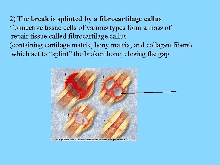 2) The break is splinted by a fibrocartilage callus. Connective tissue cells of various