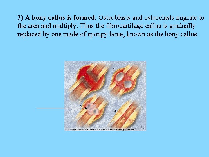 3) A bony callus is formed. Osteoblasts and osteoclasts migrate to the area and
