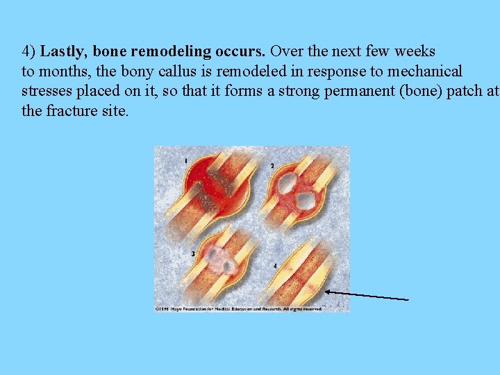 4) Lastly, bone remodeling occurs. Over the next few weeks to months, the bony