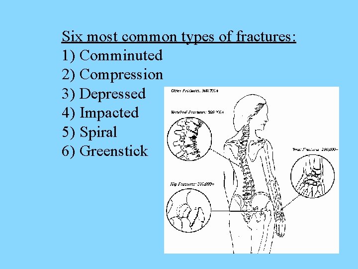 Six most common types of fractures: 1) Comminuted 2) Compression 3) Depressed 4) Impacted