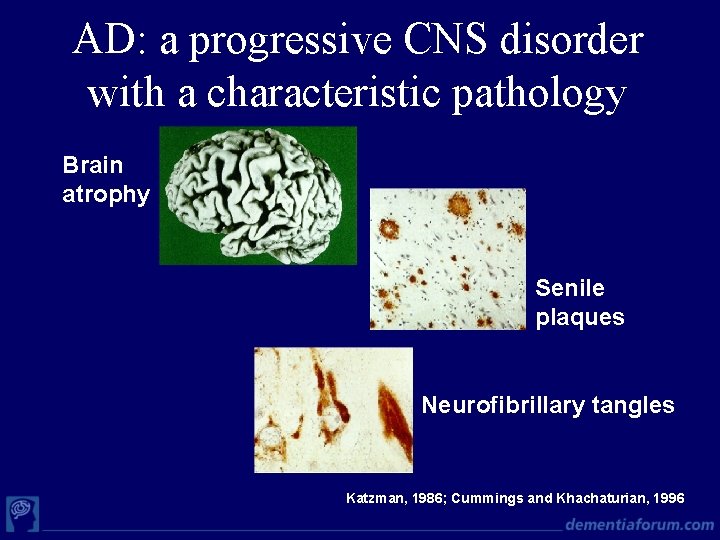 AD: a progressive CNS disorder with a characteristic pathology Brain atrophy Senile plaques Neurofibrillary
