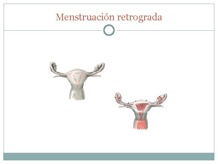 Menstruación retrograda 