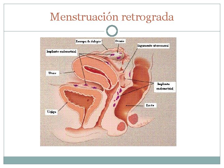 Menstruación retrograda 