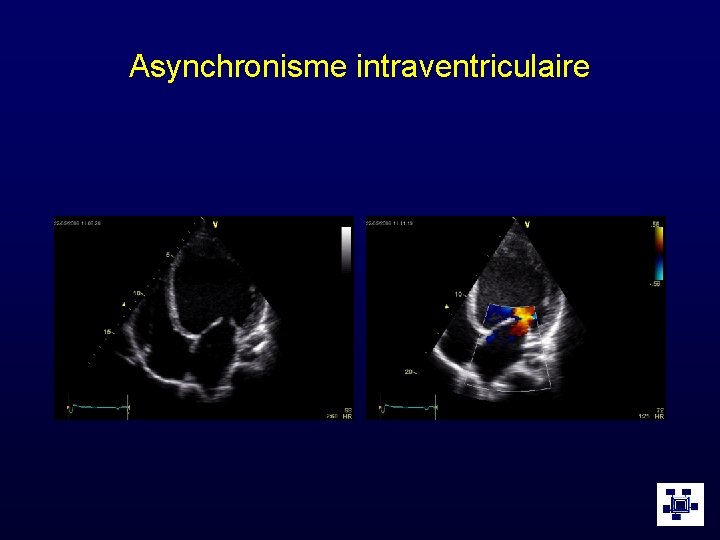 Asynchronisme intraventriculaire 