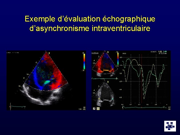 Exemple d’évaluation échographique d’asynchronisme intraventriculaire 