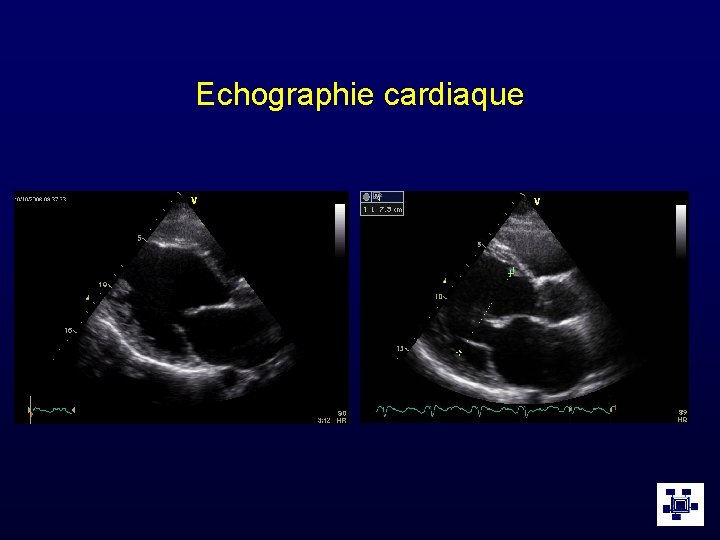 Echographie cardiaque 