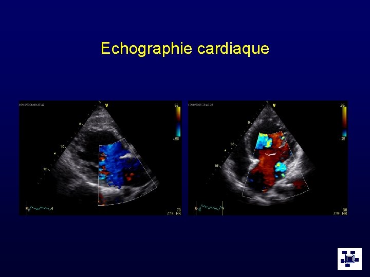 Echographie cardiaque 