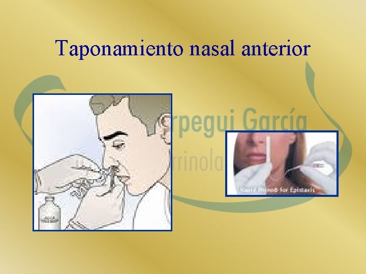 Taponamiento nasal anterior 