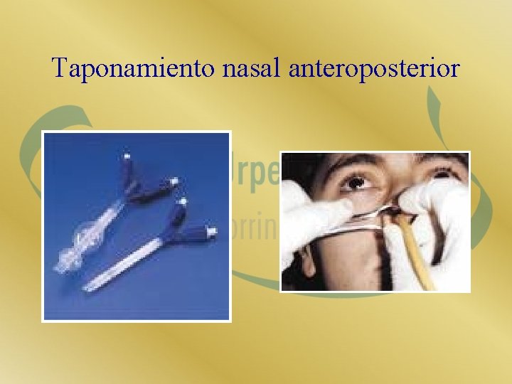 Taponamiento nasal anteroposterior 
