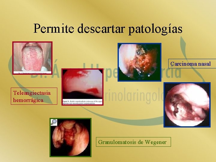 Permite descartar patologías Carcinoma nasal Teleangiectasia hemorrágica Granulomatosis de Wegener 