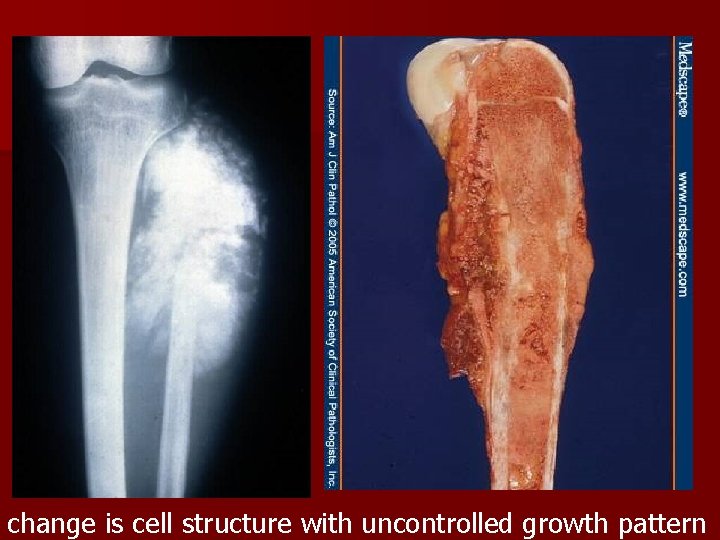 change is cell structure with uncontrolled growth pattern 