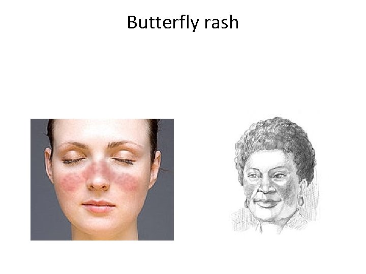 Butterfly rash 