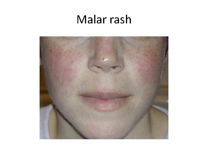 Malar rash 