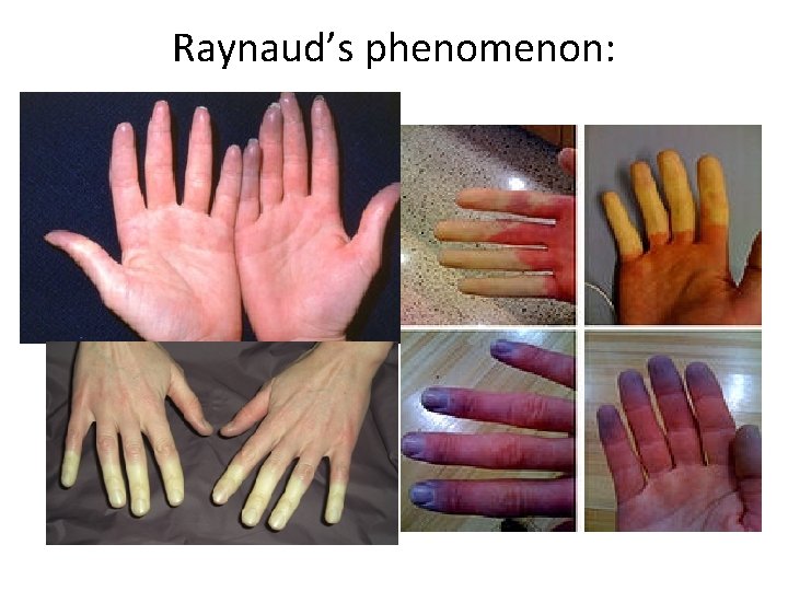 Raynaud’s phenomenon: 