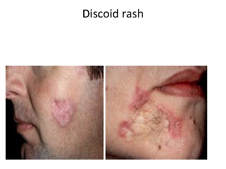 Discoid rash 