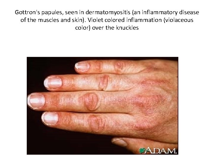 Gottron's papules, seen in dermatomyositis (an inflammatory disease of the muscles and skin). Violet