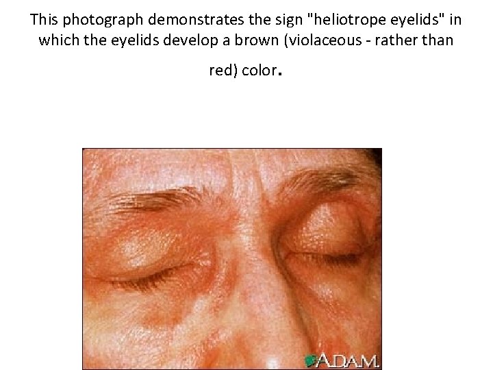 This photograph demonstrates the sign "heliotrope eyelids" in which the eyelids develop a brown