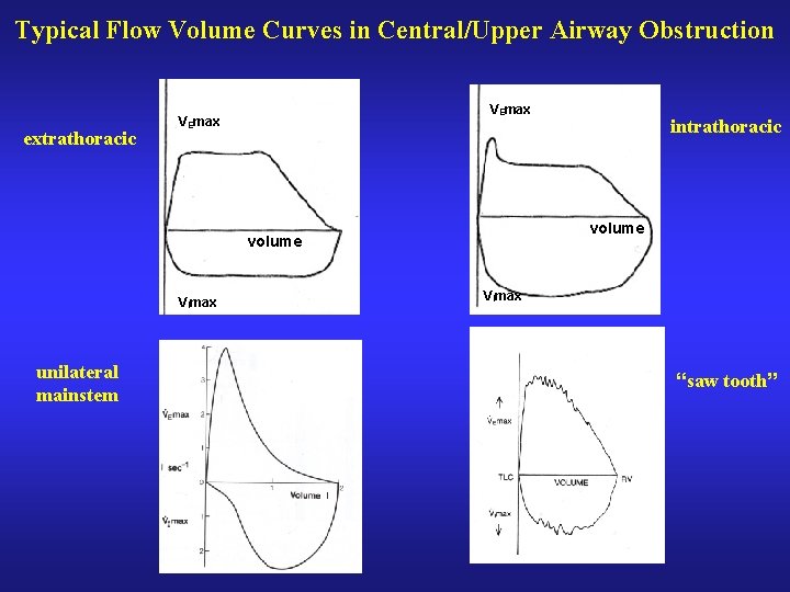 Typical Flow Volume Curves in Central/Upper Airway Obstruction extrathoracic VEmax volume VImax unilateral mainstem