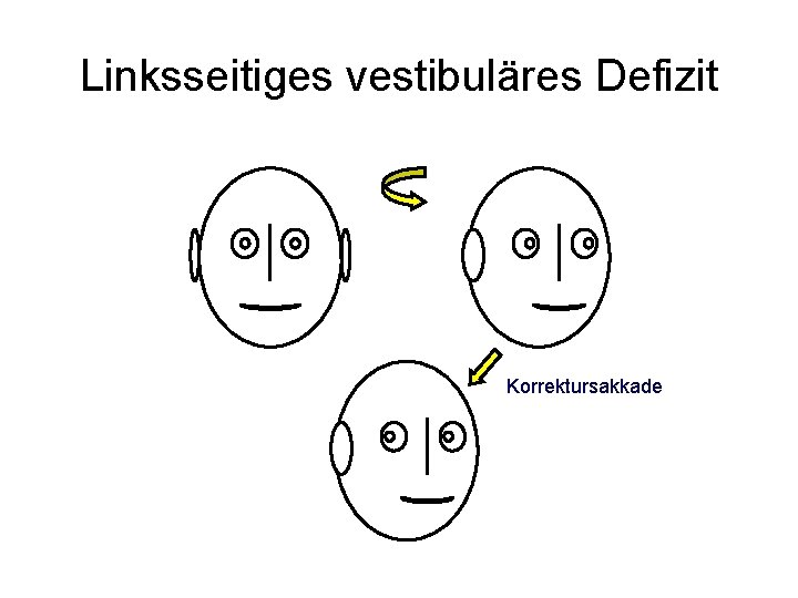 Linksseitiges vestibuläres Defizit Korrektursakkade 