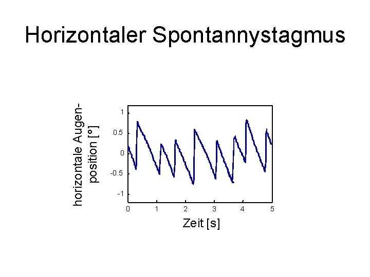 horizontale Augenposition [°] Horizontaler Spontannystagmus 1 0. 5 0 -0. 5 -1 0 1