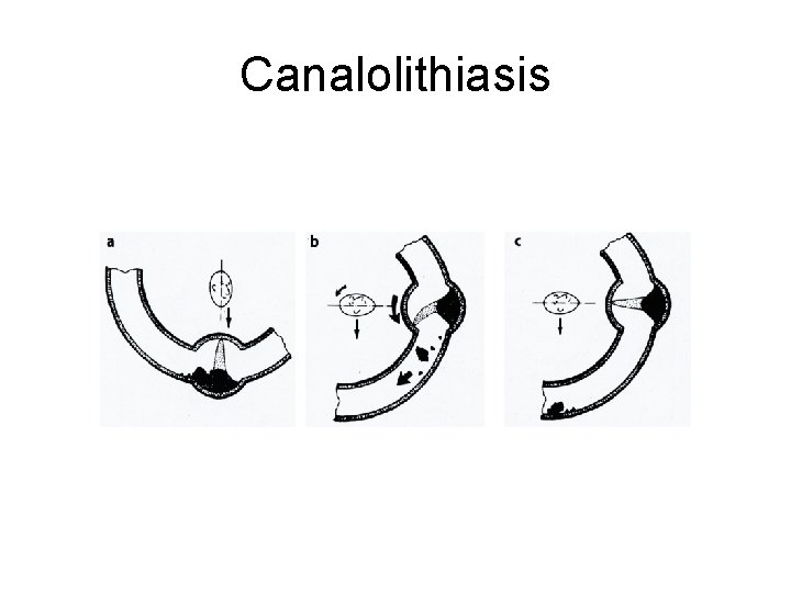 Canalolithiasis 