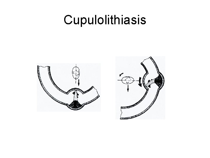 Cupulolithiasis 