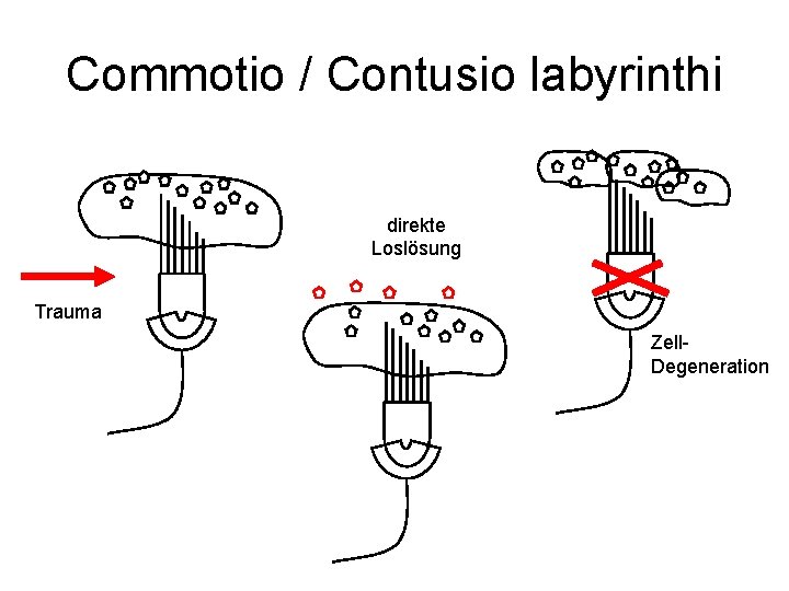 Commotio / Contusio labyrinthi direkte Loslösung Trauma Zell. Degeneration 