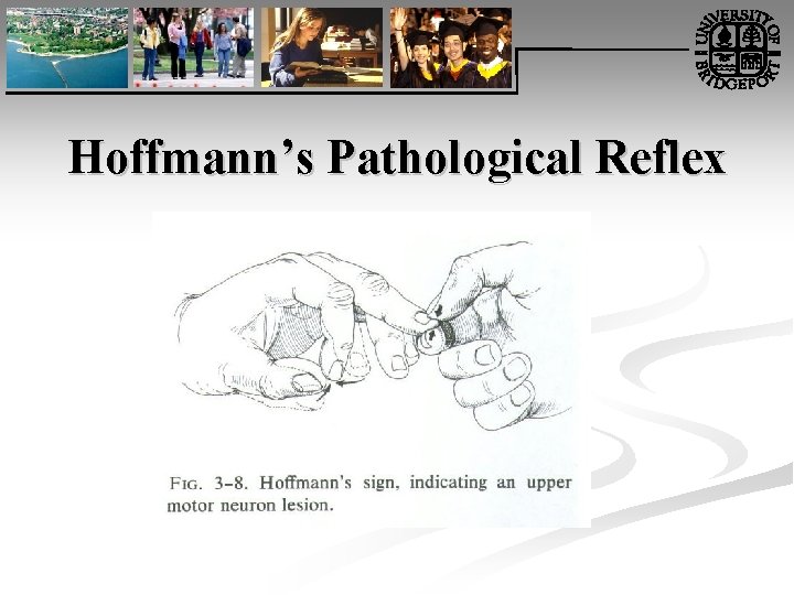 Hoffmann’s Pathological Reflex 