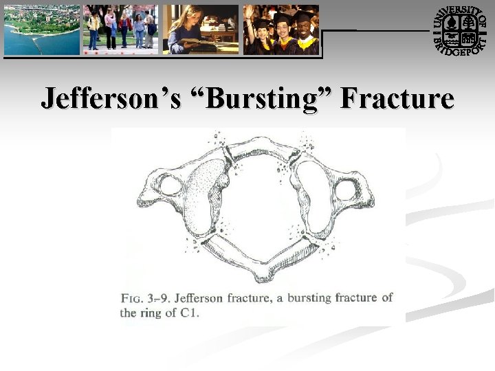 Jefferson’s “Bursting” Fracture 