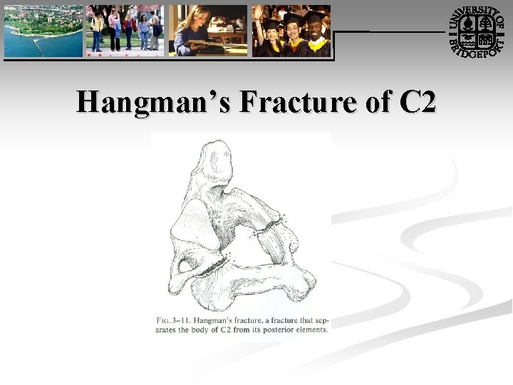 Hangman’s Fracture of C 2 