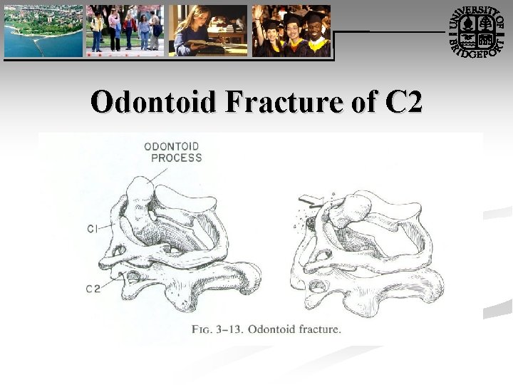 Odontoid Fracture of C 2 