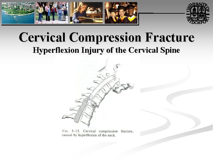 Cervical Compression Fracture Hyperflexion Injury of the Cervical Spine 