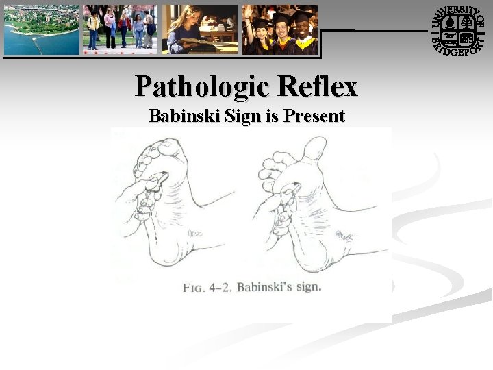 Pathologic Reflex Babinski Sign is Present 