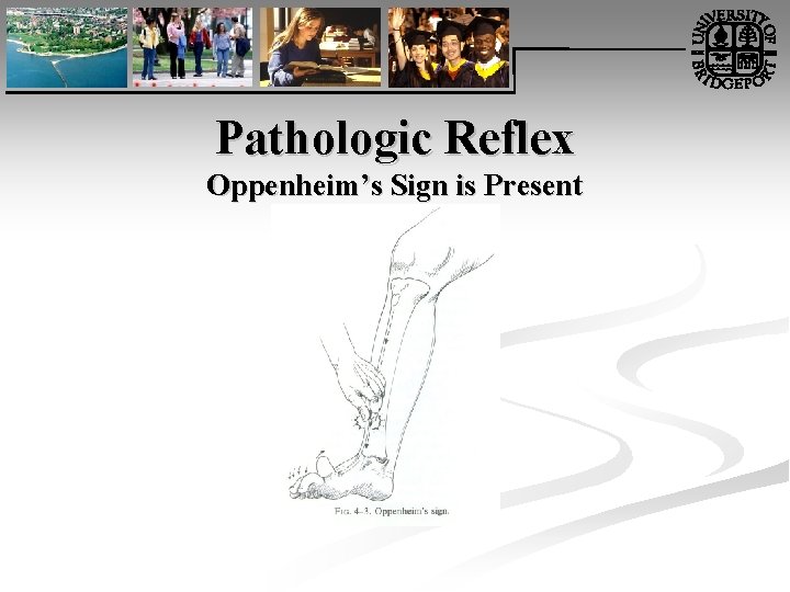 Pathologic Reflex Oppenheim’s Sign is Present 