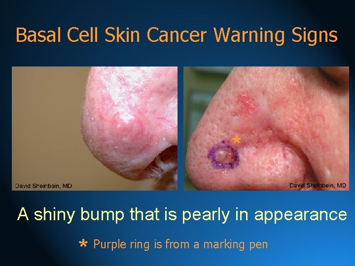 Basal Cell Skin Cancer Warning Signs * A shiny bump that is pearly in