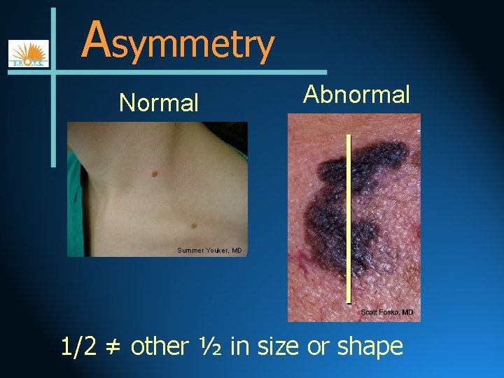 Asymmetry Normal Abnormal Summer Youker, MD 1/2 ≠ other ½ in size or shape