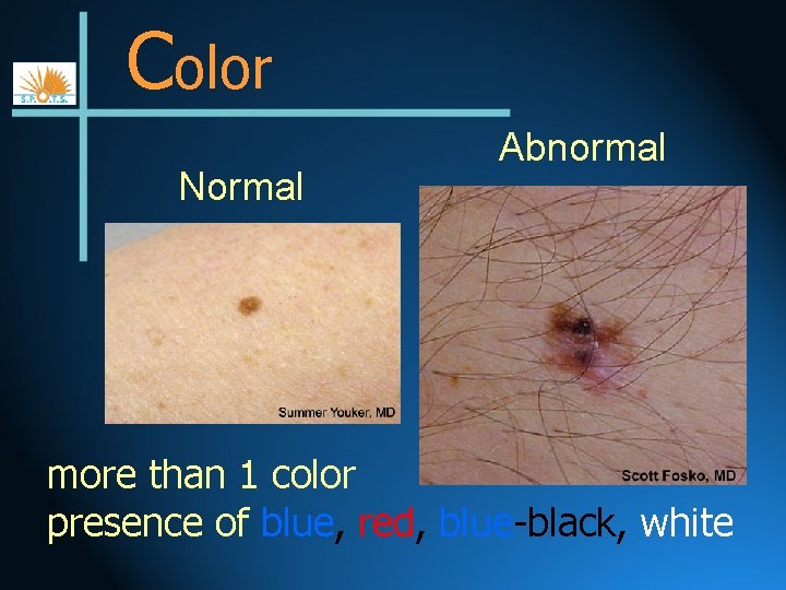 Color Normal Abnormal more than 1 color presence of blue, red, blue-black, white 