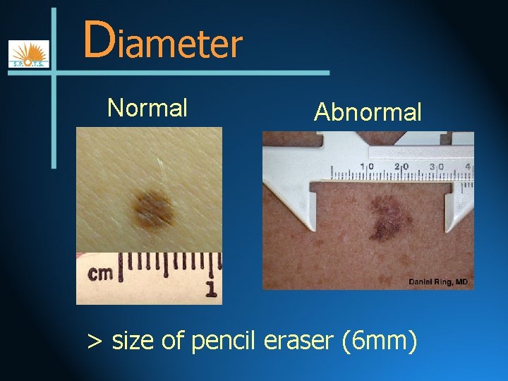 Diameter Normal Abnormal > size of pencil eraser (6 mm) 