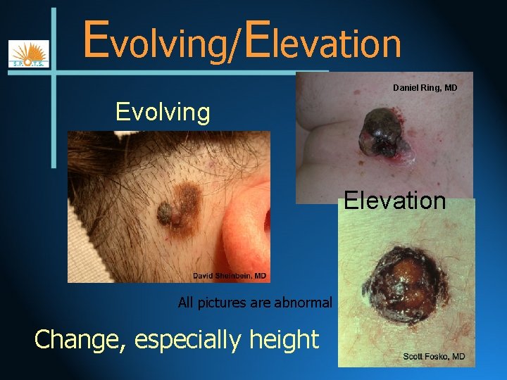 Evolving/Elevation Daniel Ring, MD Evolving Elevation All pictures are abnormal Change, especially height 