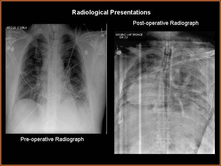 Radiological Presentations Post-operative Radiograph Pre-operative Radiograph 